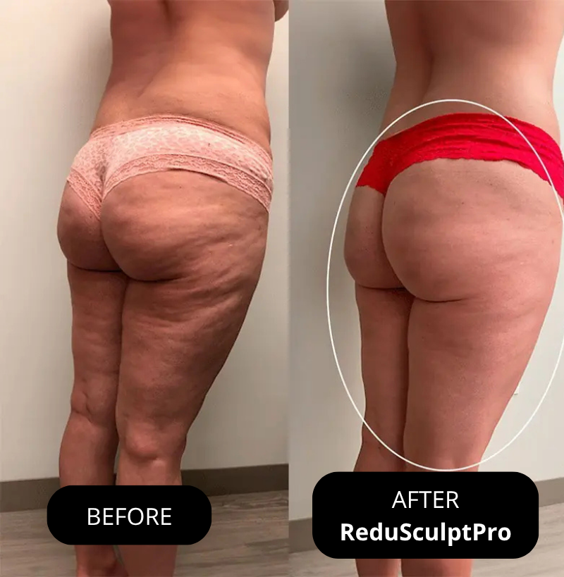 Amiuri ReduSculptPro™ Kit (FREE Retinol Serum Included)