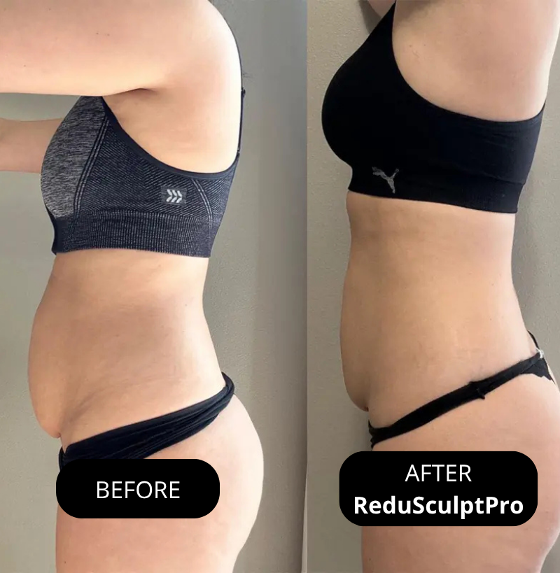 Amiuri ReduSculptPro™ Kit (FREE Retinol Serum Included)
